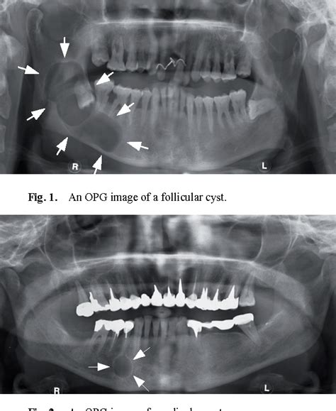 Figure 4 From Classification Of Jaw Bone Cysts And Necrosis Via The