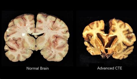 Ub Psychiatry Resident Explores Link Between Brain Injuries Suicide