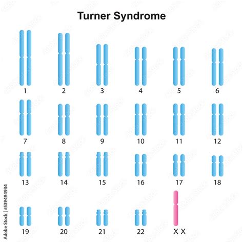 Scientific Designing Of Turner Syndrome Monosomy X Karyotype Colorful Symbols Vector