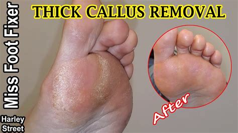 Corns and calluses are hard, thickened areas of skin that form as a result of friction or pressure on the skin. SATISFYING THICK FOOT CALLUS REMOVAL BY MISS FOOT FIXER ...