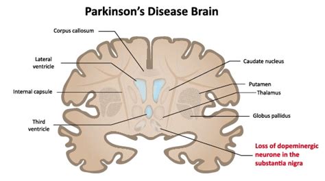 A report of two cases. Living with Parkinson's Disease - Flagstaff Business News