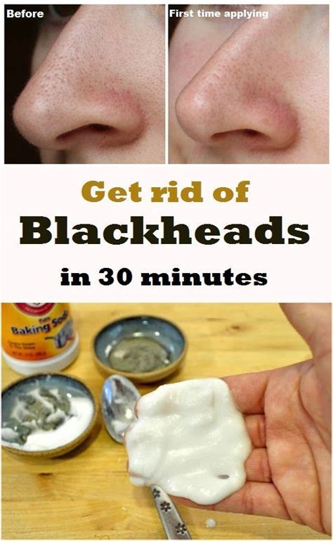 7 Diy Blackhead Remedies To Try At Home