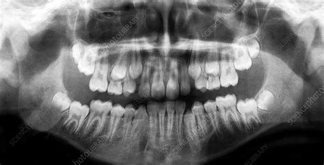 Emergence Of Adult Teeth X Ray Stock Image C0021299 Science