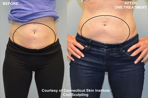 Coolsculpting Before And After Picture Of Lower Abdomen Connecticut Skin Institute