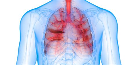 These types of lung cancer grow differently and are treated differently. Tecentriq Plus Chemotherapy Slows Progression of Advanced ...