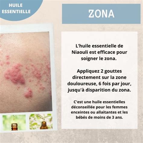 Traitement zona avec les huiles essentielles Huiles essentielles et aromathérapie