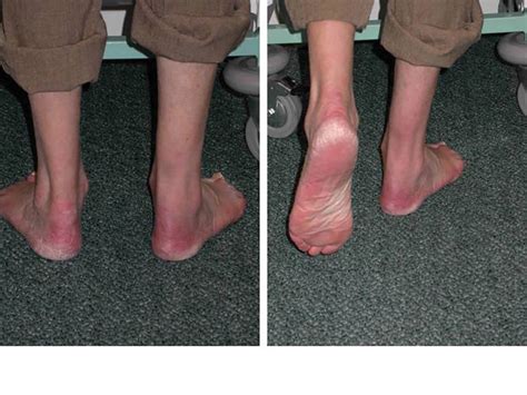 Ruptured Achilles Tendon The Foot And Ankle Clinic