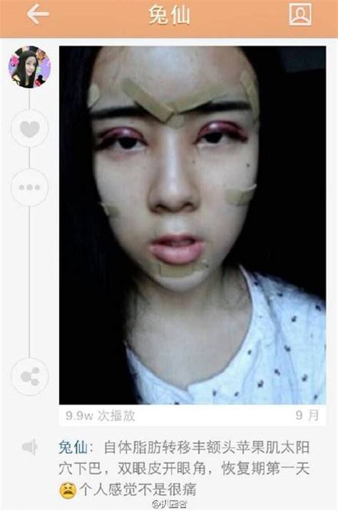 Chinese Teen Undergoes Extreme Surgery To Resemble Porcelain Doll