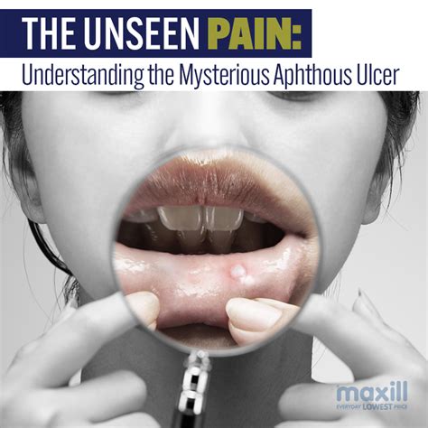 The Unseen Pain Understanding The Mysterious Aphthous Ulcer