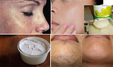 Beauty Home Remedies For Black Spots On Your Face Black Spot Home