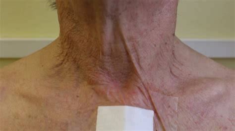 Normalized Venous Filling Of Both External Jugular Veins Without