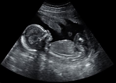 How your baby is developing now you're 4 weeks pregnant. 2D Early Pregnancy Scans Dublin (Dating Scans) | Ultrascan.ie