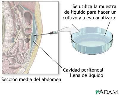 Medlineplus Enciclopedia M Dica Cultivo Peritoneal