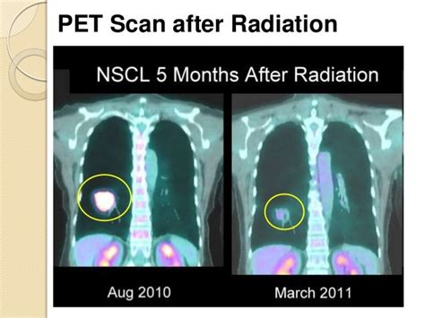 Radiation For Lung Cancer