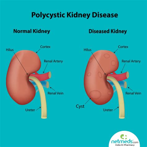 Polycystic Kidney Disease Causes Symptoms And Treatment