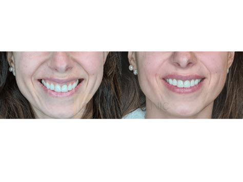 Gingival Smile Treatment Living Clinic
