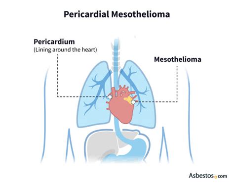 Types Of Mesothelioma Discover Different Mesothelioma Types