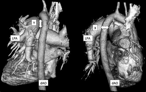 Anatomical Considerations For The Development Of A New Transcatheter