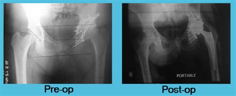 Total Hip Replacement Sant Parmanand Hospital