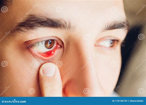 Infected Sty Barley Purulent Eye Man Pulls Down Lower Eyelid Showing