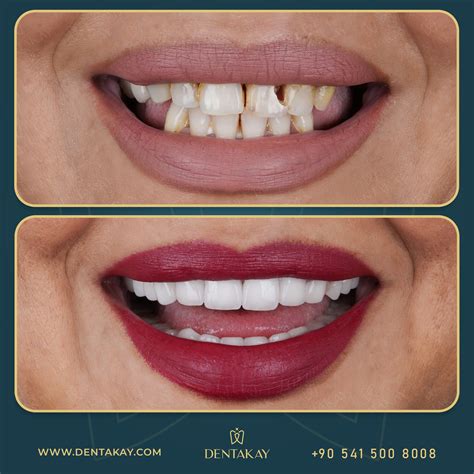 Zirconia Crowns Before And After Results In 2021 Cosmetic
