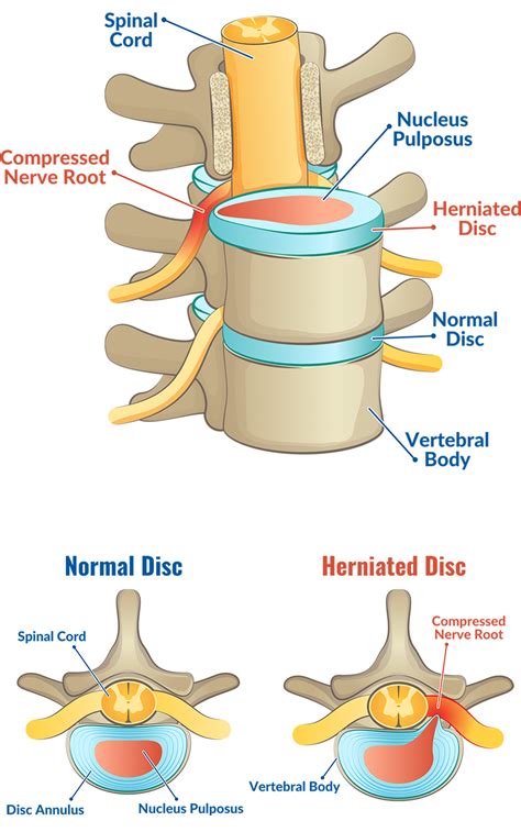 5 Unexpected Symptoms Of A Herniated Disc Core Orthopedics