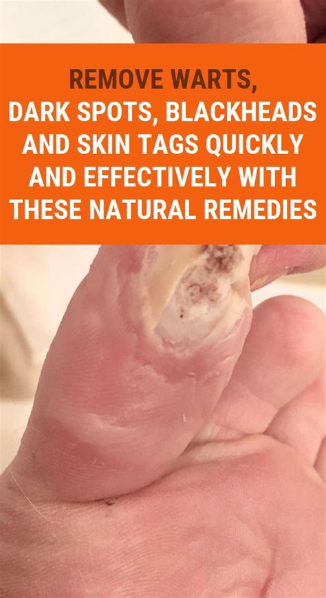 Remove Warts Dark Spots Blackheads And Skin Tags Quickly And