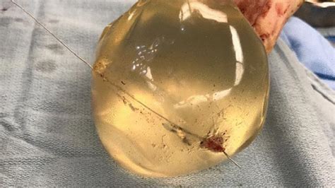 Womans Breast Implant Deflects Bullet Saving Her Life Cnn