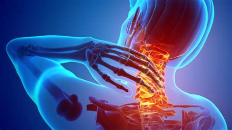 Neck Sprain Causes Symptoms Diagnosis And Treatments Reliefly