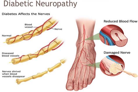 Diabetic Neuropathy Causes Symptoms Signs Medications Treatment