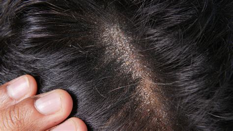 Dermite séborrheique Quelles conséquences sur la perte de cheveux