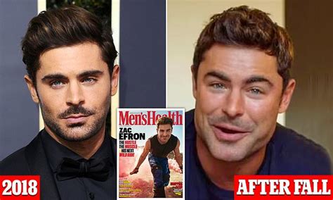 Zac Efron Plastic Surgery Before And After Jaw Dropping Transformations