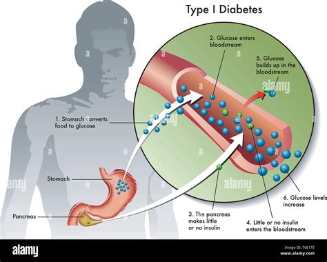 Type 1 Diabetes Diagram Pancreas