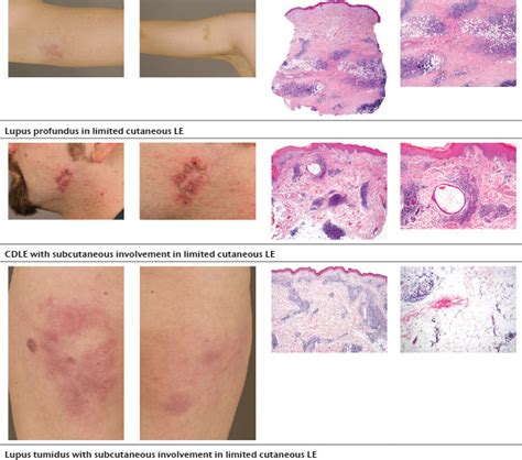 Lupus Erythematosus Part Ii Clinical Picture Diagnosis And Treatment