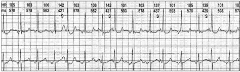 Examples Of Wandering Atrial Pacemaker Wap Pacemaker Atrial Wandering