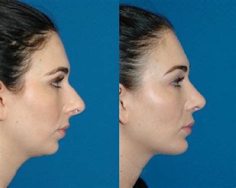 Non Surgical Nose Job Nyc Dr Gary Rothfeld 629 Park Ave Nyc