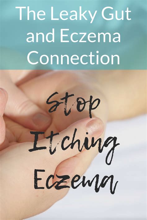 The Eczema And Leaky Gut Connection Eczema Eczema Remedies Eczema