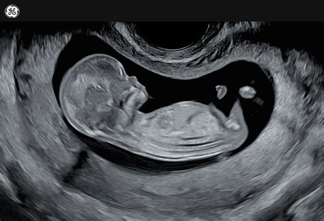 Ultrasounds Role In Maternal Fetal Bonding Empowered Womens Health