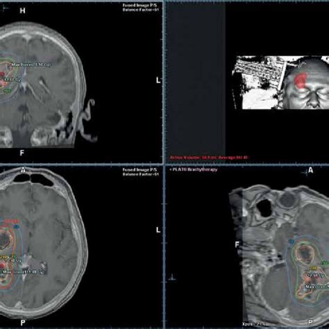 Multiplanar Three Dimensional View Of The Planning Computed Tomography