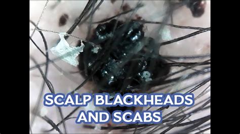 Blackheads Ingrown Hairs And Scabs On My Scalp Microscopic Happy
