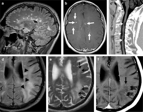Magnetic Resonance Imaging Mri In Diagnosis And Safety Monitoring Of Download Scientific