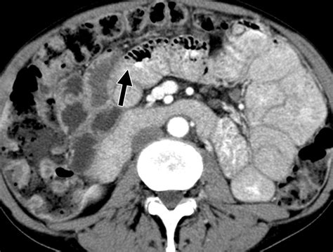 Ct Findings In Adult Celiac Disease Radiographics