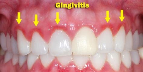 How To Get Rid Of Gingivitis Fast And Easily At Home