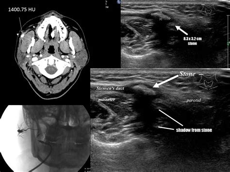 Complication From Open Parotid Ductoplasty For Stone With Parotid