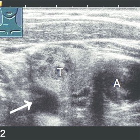 Color Coded Doppler Ultrasonography Shows A Parathyroid Adenoma