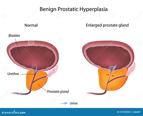 Hiperplazia De Prostata Cauze Simptome Tratament Sfaturimedicale Ro Hot Sex Picture