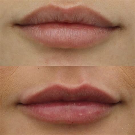 The Perfect Pair Of Lips Injections Fillers And Augmentation Vida