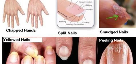 But more commonly, it's the result of an iron deficiency. nails your health indicator | Nail health signs, Natural ...