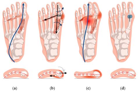 Jcm Free Full Text Forefoot Function After Hallux Valgus Surgery A