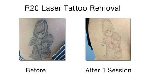 Remove Your Unwanted Tattoo With The Best Tattoo Removal In Nyc Do Not